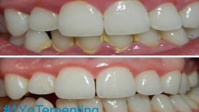 Menghilangkan Karang Gigi, Mencegah dan Caranya