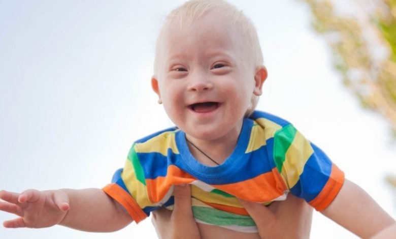 Cara Mudah Mengatasi Down Syndrome Pada Anak